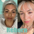 Women Beauty Skincare Products Reborn PLLA Hydrogel