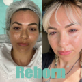 Face Collagen Regeneration Injectable Liquid Dermal Filler