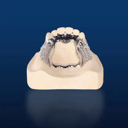 Bego Metal Partial Denture