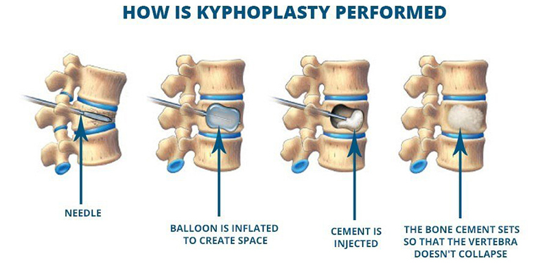 Kyphoplasty Balloon Catheter