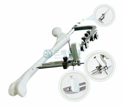 Femur Magnetic Guided Nail Intramedullary Nail
