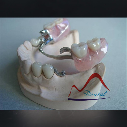 Bolt Attachment changes Partial Denture Prosthodontics - Suginaka “Riegel Dental Precision Attachment Partial Denture Ivoclar Scheftner