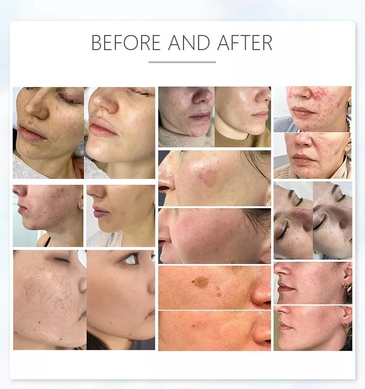 best laser removal machine