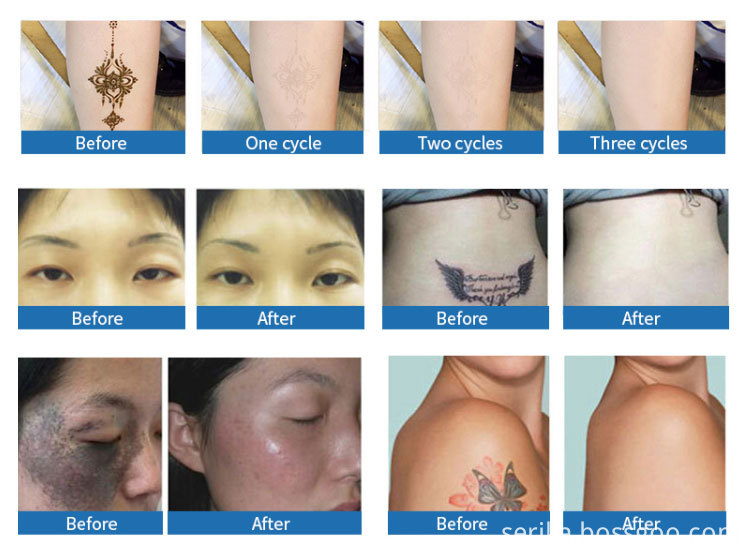 Laser Hair Removal Equipment