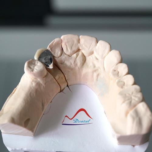 3/4 Porcelain Metal Crown