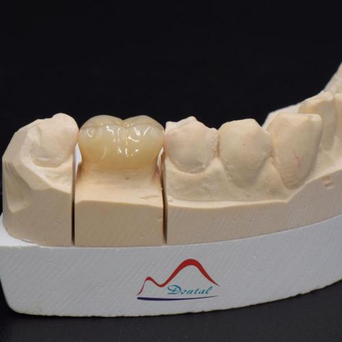 Posterior IPS e.max Press Prosthesis