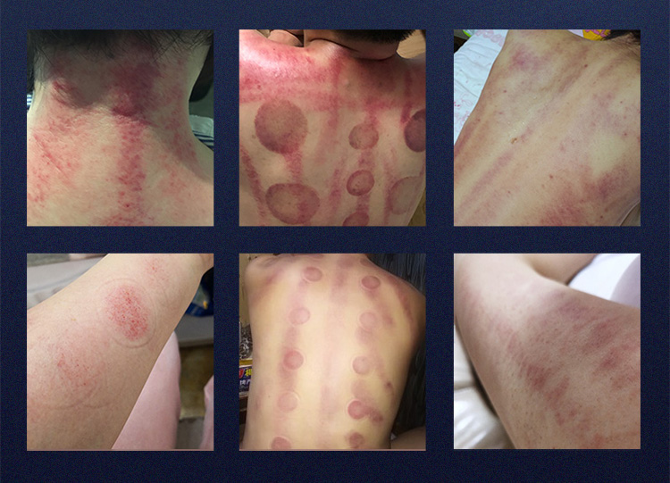 cavitation machine for body fat removal