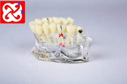 Dental Model Upper Half: Implant and Restoration