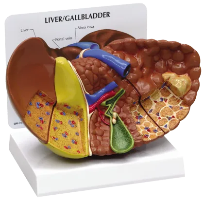Nature Sized Human Diseased Liver Cancer Structure Model