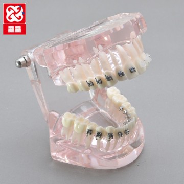 Self Ligating Ceramic Lingual Brackets Orthodontic Demonstration Model