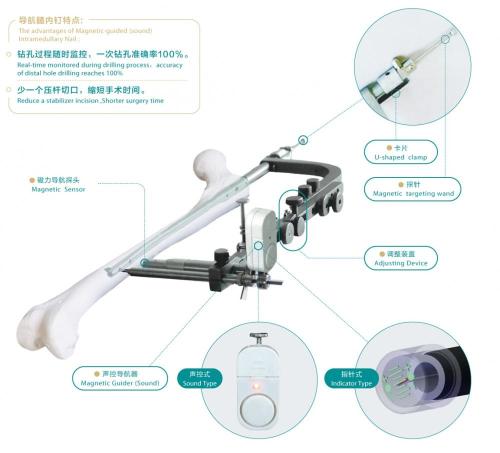 Magnetic guided Intramedullary nail femur