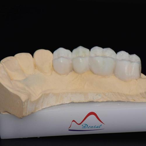 Posterior Aestherics Diagnostic Wax Up