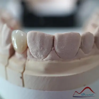 Dental Anterior Zirconia Restoration