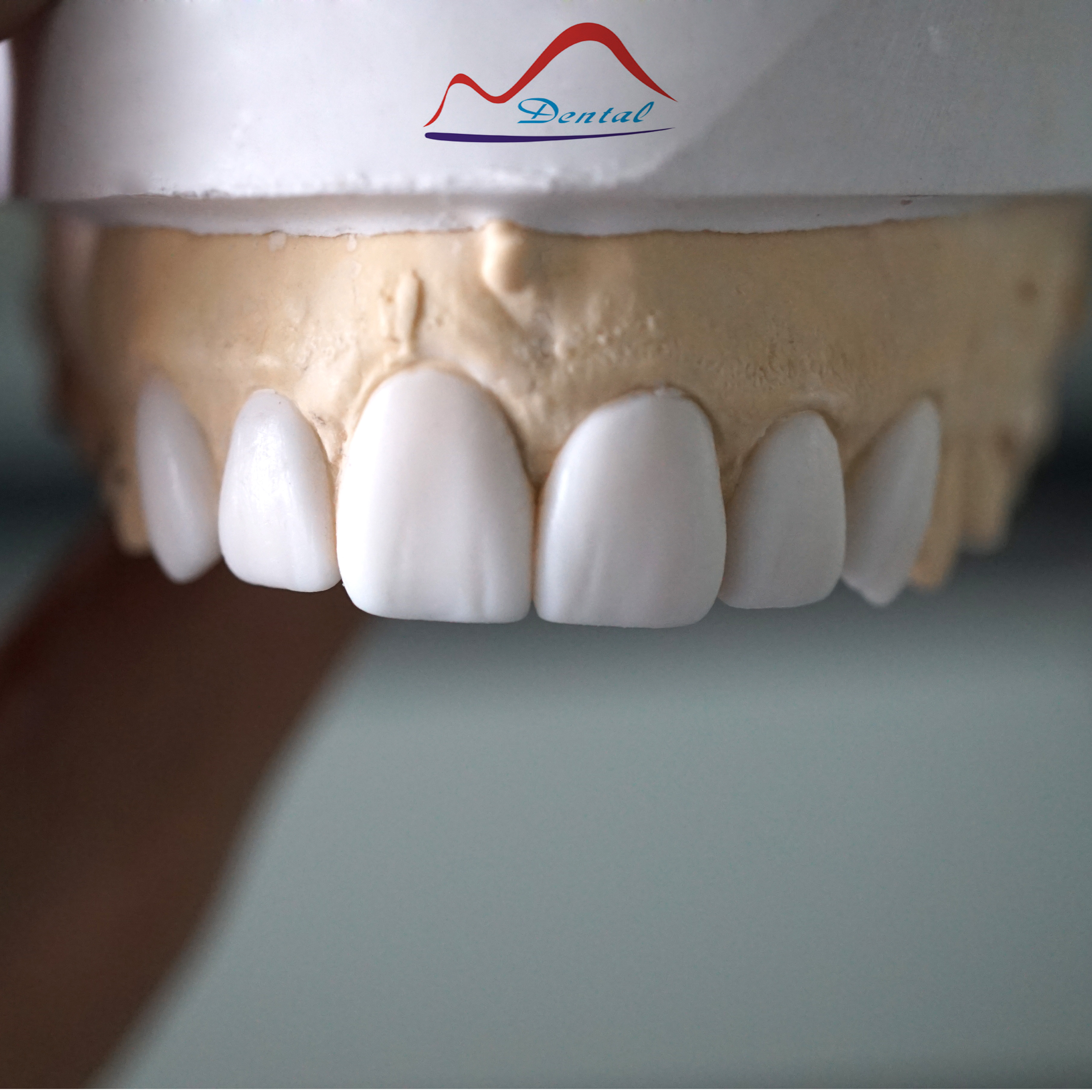 Diagnostic Wax Up
