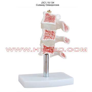 Cutaway Osteoporosis-J3C1.19.134