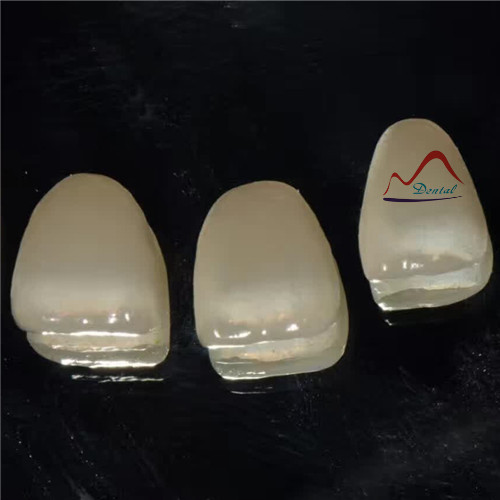 Dental All Ceramics CC Veneers