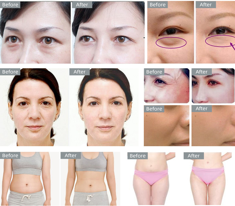 3in1 radiofrequency and body cavitation machine