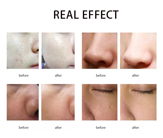 Mesotherapy Before And After