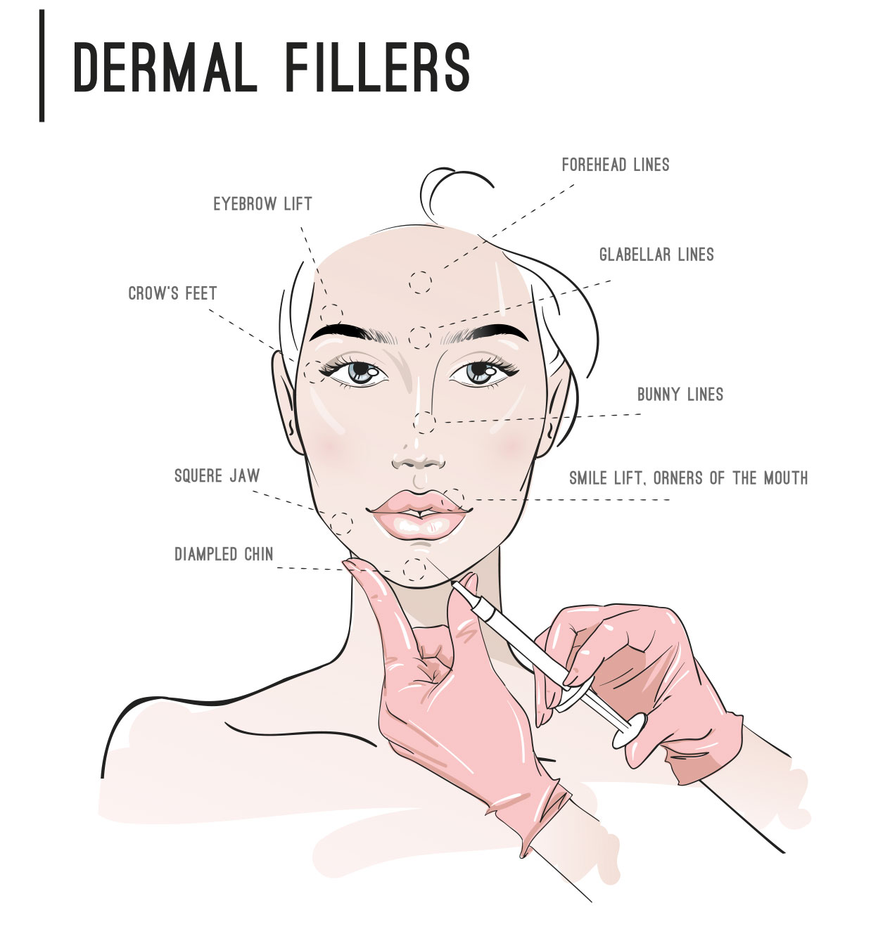 dermal filler