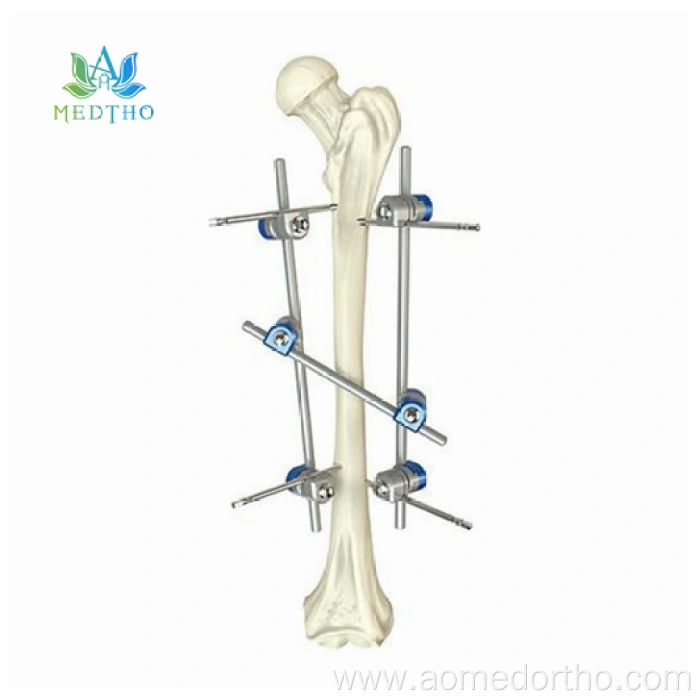 ex fix tibia China Manufacturers Suppliers Factory Exporter