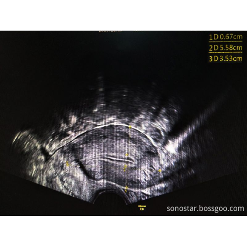 Venda quente 128Element Color Doppler Sonda Transvaginal