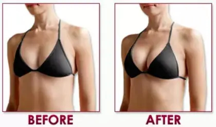 Hyaluronic acid breast injection breast enlargement