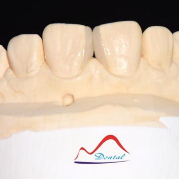 Super Thin Veneer To Close The Diastema