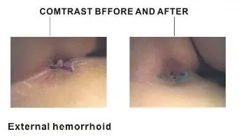 Anorectal Treating Device LG2000b for Hemorrhoids Surgery