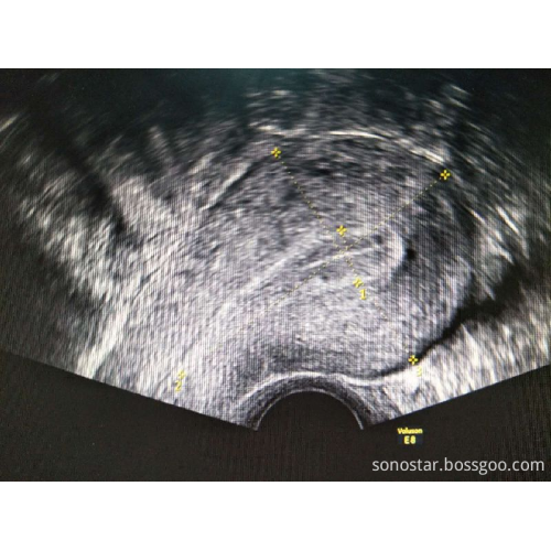 Venda quente 128Element Color Doppler Sonda Transvaginal