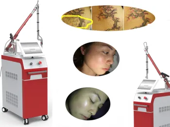 1064,532nm Q Switch Nd Yag Laser Tattoo Removal Machine