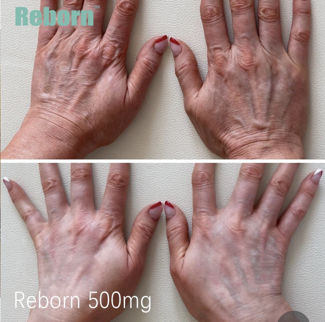 Reborn PLLA dermal filler for hands rejuvenation