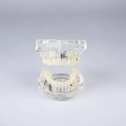 Pathological Dental Implant Restoration Model for Demonstration