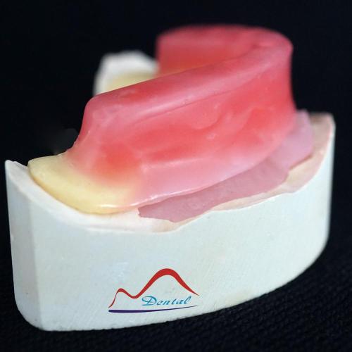 Implant Wax Rim Try In