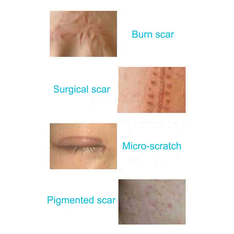 Scar Removal Cream Face Cream Acne Stretch Marks Removal Cream Smooth Skin Natural Renewal Healing Skin Repair Product