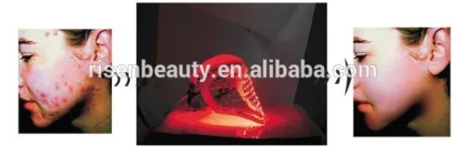 acne scar removal skin care LED Mask