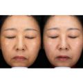 Safe Medical Aesthetics for Beauty Facial Rejuvenation