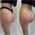 Perfect Body Buttock Breast PLLA Injections For Sale