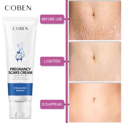 Private Label Female Body Stretch Mark Removal Lotion