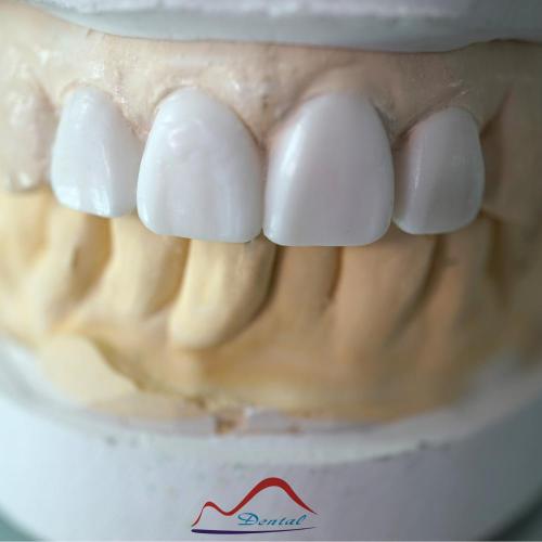 Aesthetic Dental Diagnostic Wax-up