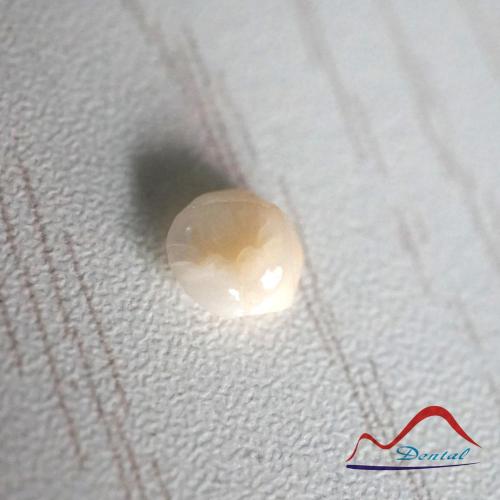 Dental Composite Resin Onlay