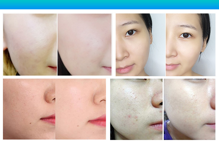 dermabrasion home treatment