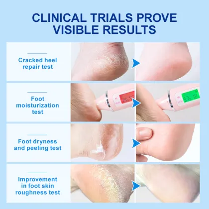 Wholesale Private Label Organic Foot Cream - 42% Urea Anti-Cracking Peel Off Foot Cream with Salicylic Acid