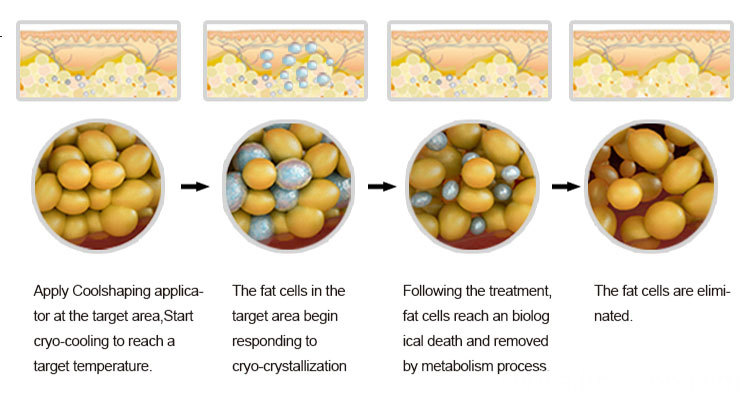 Fat Freezing And Cavitation