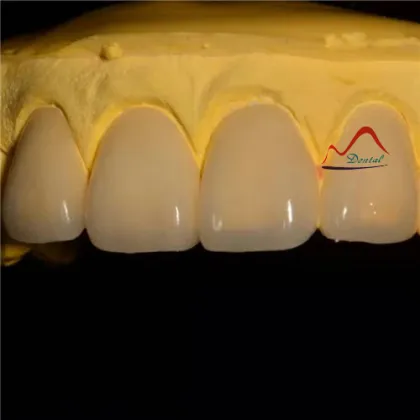 Dental All Ceramics CC Veneers