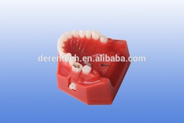 comprehensive restoration teeth model