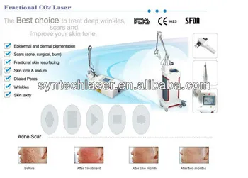co2 fraction medical laser for clinic and beauty salon with medice Ce and FDA