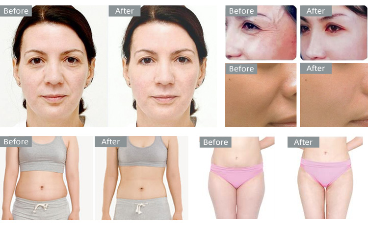 cavitation machine home