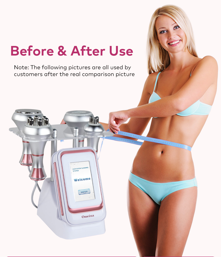 cavitation fat reduction