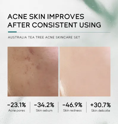 OEM Tea Tree Extract Organic Skin Care Set: Soothing, Pore Shrinking, Hydrating & Repairing