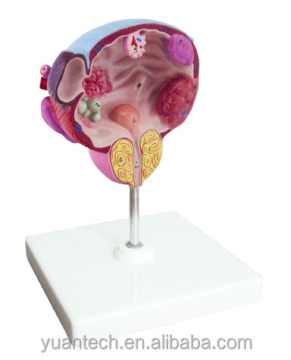 Male Bladder and Prostate Anatomy Model - Diseased Structure for Medical Education